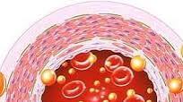 Clear Clogged Arteries (Atherosclerosis) Using This Great Natural Remedy Clear Clogged Arteries (Atherosclerosis) Using This Great Natural Remedy